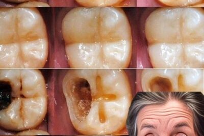 How to Naturally Repair a Cavity and Strengthen Your Teeth